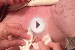 Massive Sebaceous Cyst, Definition, Education and Discussion!